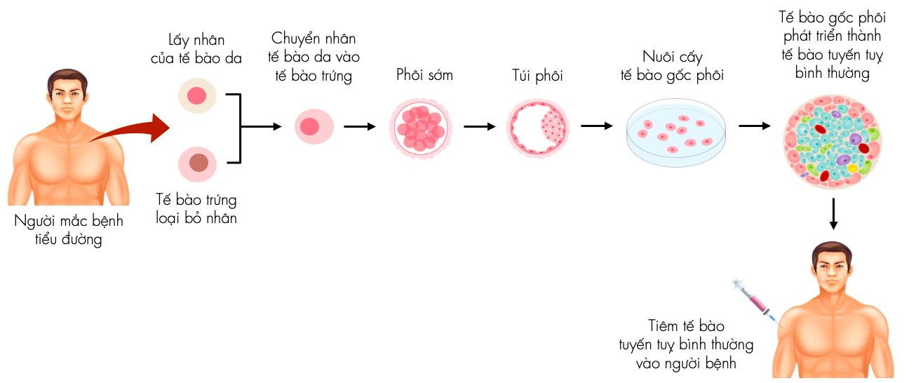 Liệu pháp tế bào gốc để chữa bệnh tiểu đường type 1